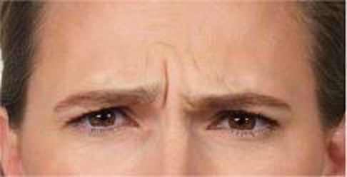 Glabellar (frown) lines at maximum frown — before treatment with Dr. Boris Zaks, MD, Beverly Hills