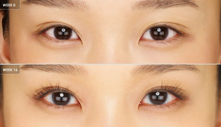 Baseline vs. week 16 of nightly use — after treatment with Dr. Boris Zaks, MD, Beverly Hills