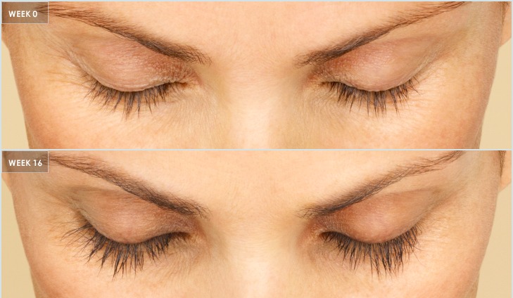 Baseline vs. week 16 of nightly use — before treatment with Dr. Boris Zaks, MD, Beverly Hills
