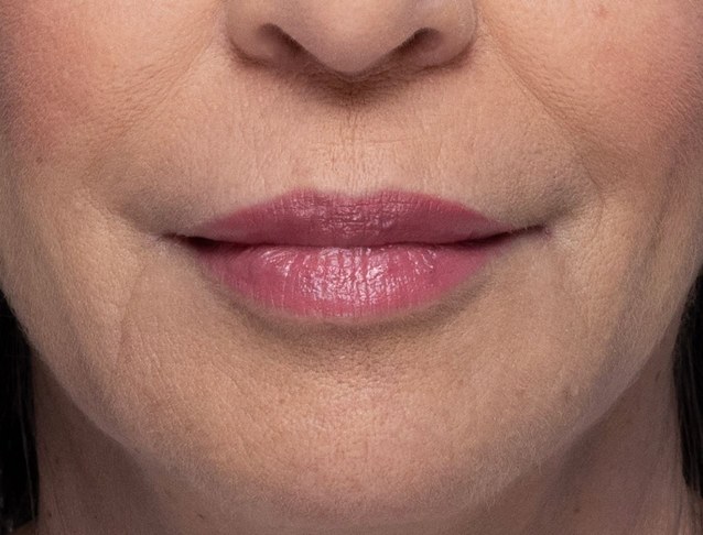 Upper lip shaping — after treatment with Dr. Boris Zaks, MD, Beverly Hills