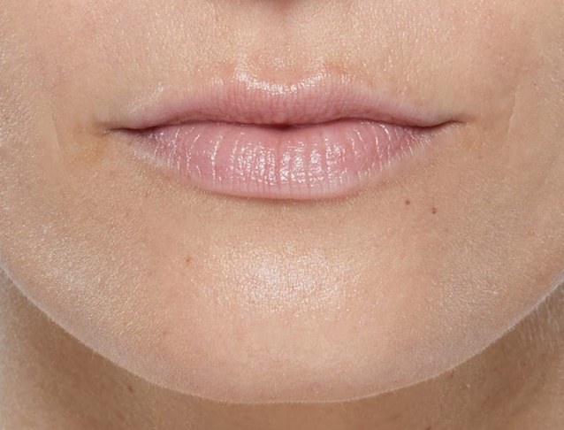 Lip volume and border definition — before treatment with Dr. Boris Zaks, MD, Beverly Hills