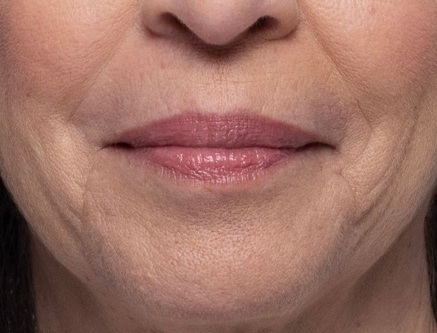 Upper lip shaping — before treatment with Dr. Boris Zaks, MD, Beverly Hills