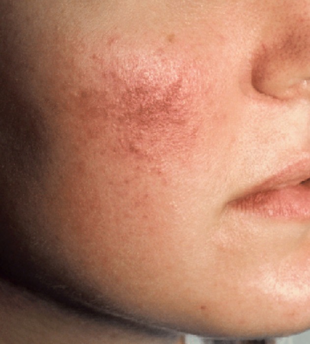 Facial telangiectasias treated with the Vbeam® pulsed dye laser — after treatment with Dr. Boris Zaks, MD, Beverly Hills