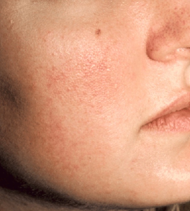 Facial telangiectasias treated with the Vbeam® pulsed dye laser — before treatment with Dr. Boris Zaks, MD, Beverly Hills