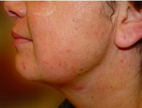 Lower face and jowl tightening — after treatment with Dr. Boris Zaks, MD, Beverly Hills
