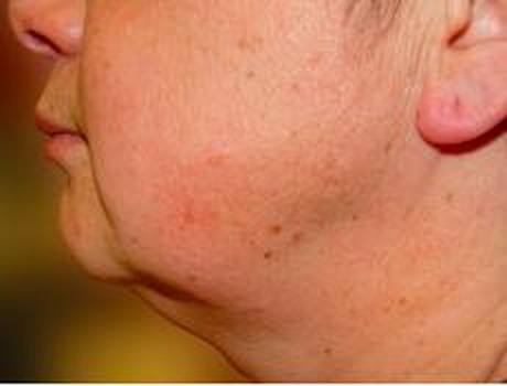 Lower face and jowl tightening — before treatment with Dr. Boris Zaks, MD, Beverly Hills