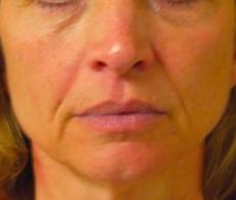 Neck and submental laxity — before treatment with Dr. Boris Zaks, MD, Beverly Hills