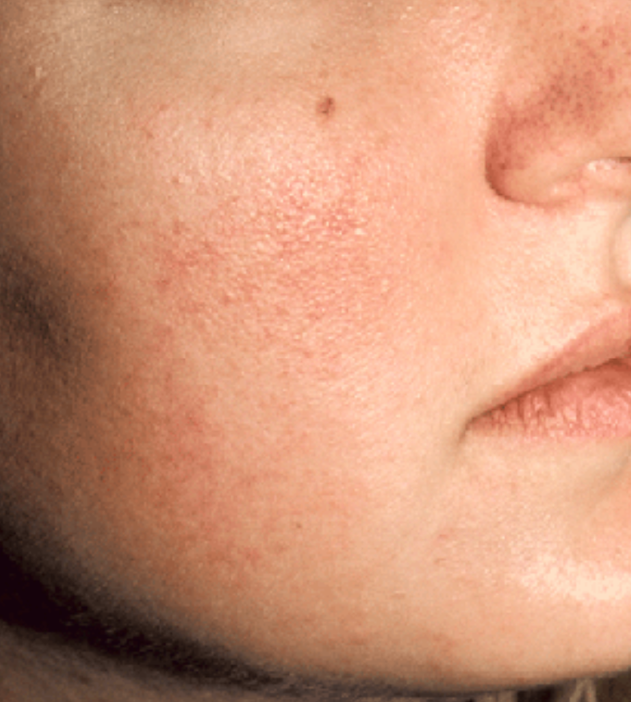 Rosacea redness treated with the Vbeam® pulsed dye laser — before treatment with Dr. Boris Zaks, MD, Beverly Hills